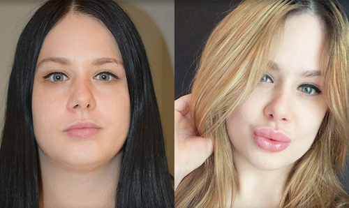 Natural Lip Filler Enhancement Before After Mississauga Lip Doctor